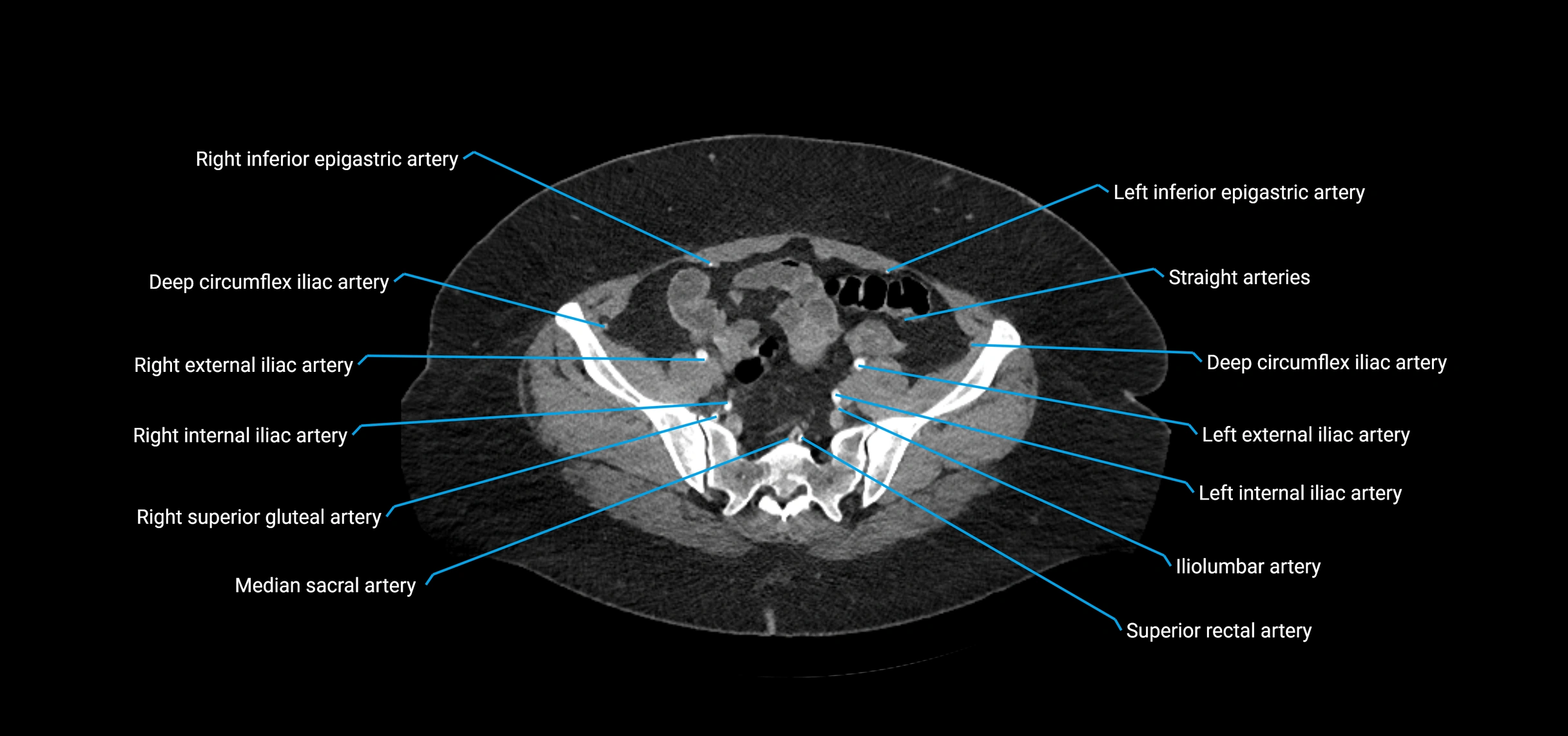 CTA abdomen axial cross sectional anatomy labelled image_198 (2).webp